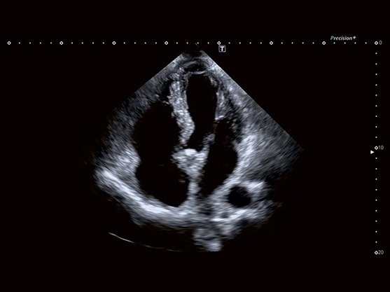 تصویر  سونوگرافی - اکوکاردیوگارفی Aplio i900